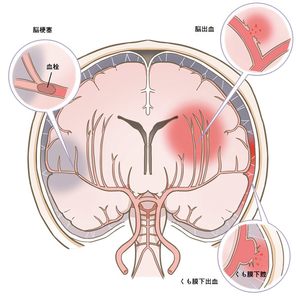 脳の血管が詰まる・破れる「脳卒中」