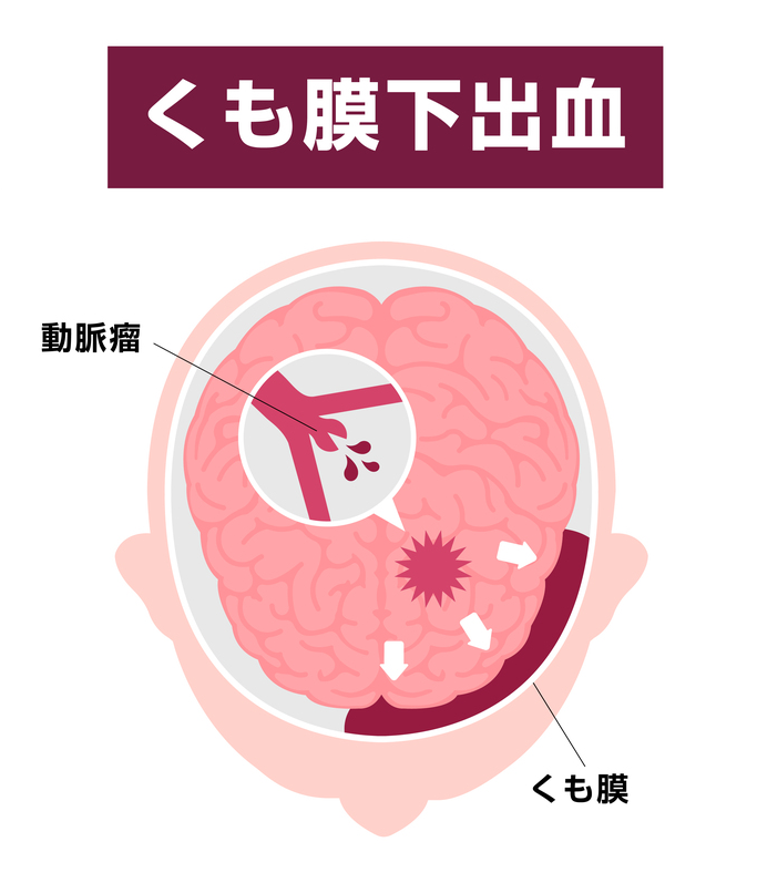 くも膜下出血とは